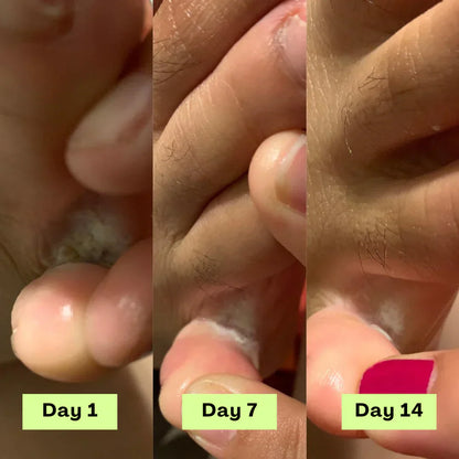 NEGUSY™ Tea Tree Athlete's Foot Defense Soap